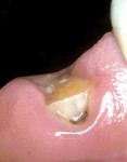 Figure 12  Mandibular canine fractured at the gingival line before endodontic and periodontal treatment.**
