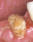 Figure 13  Canine after endodontic treatment and crown-lengthening surgery.**