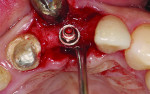 Figure 3 Final implant placement in correct horizontal and vertical positions.