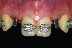 Figure 13 Standard metal abutments showing discoloration of the peri-implant soft tissue.