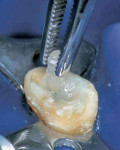 Figure 15  Fiber post cemented into root canal.**