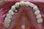 Figure 11 Definitive screw-retained restoration. Creative dental technician work allowed the incorrectly placed implant to be used in the restoration. However, it still creates a long-term maintenance challenge due to the buccal-lingual cantilever.