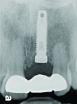 Figure 6 The soft tissues will subsequently heal over the healthy implant allowing primary closure of the flap if subsequent augmentation is required. A resin-bonded retained provisional bridge is used as a transitional fixed restoration. A fixed provisional is more advantageous if subsequent surgery is required.