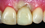 Figure 11 Roughly one month after stage 2 uncovering, a new acrylic provisional crown restoration was made and used to sculpt the soft tissue shape.