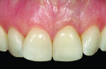 Figure 14 The final cement-retained crown restoration on implant tooth No. 9 showing a harmonious blend and balance of periodontal health as well as white and pink color integration.