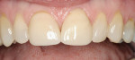 Figure 1  The central incisors with leakage.