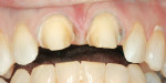 Figure 3  Occlusal view of the Cercon preparation.