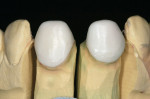 Figure 4  Cercon Art precision fit is verified before Ceramco layering porcelain is applied.