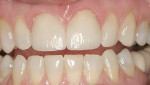 Figure 7  Cercon Art cemented to place on two central incisors.