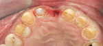 Figure 9  Teeth prepared for Cercon Bridge and crowns.