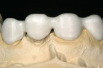 Figure 10  Cercon restorations mounted on the die model before Ceramco PFZ porcelain layering.