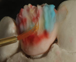Figure 16 Opalescence was added with
powder porcelain shade EOP-3.