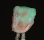 Figure 18 Powder dentin shade C1 was added to halo effect.