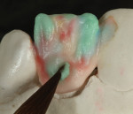 Figure 17 Additional translucent modifier, TM01 in blue, was added to the mesial and distal aspects.