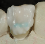 Figure 23 A darker enamel shade E 60 was built up over entire labial surface,
covering all of the characterized buildup.