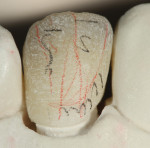 Figure 27 Red and black lines were placed to identify the contour and texture
over labial surfaces.