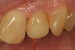 Figure 30 Lustre paste application
was reviewed in the patient’s
mouth for shade selection and
placement of additions.