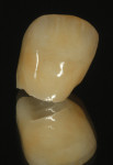 Figure 29 The glazed restoration was
accessed for placement of external
characterization with Lustre paste.