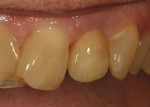 Figure 31 Immediate insertion of
restoration with teeth dehydrated
reveals the accuracy of the shading.
