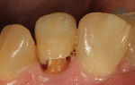 Figure 33 Occlusal photographs show integrity of central appearance and incisal characteriazation.