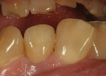 Figure 34 Occluding dentition in the
photograph show the placement of accurate characterization and how the color relates to the occluding dentition.