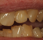 Figure 37 The restoration blends naturally
with surrounding dentition.