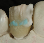 Figure 22 Additional translucent blue TM-01 and translucent opal TO were added
to the mesial contact and over the middle 1/3 horizontal craze line.
