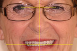 Figure 19 Calibrated facial analysis of anterior tooth position.