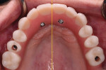 Figure 23 Occlusal view of definitive All-on Four with palatal midline analysis.