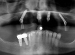 Figure 1 A panorex radiograph showing maxillary All-on-Four implant placement.