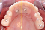 Figure 4 Occlusal view of maxillary transitional
hybrid with vertical calibration line determining
position of tooth midline in relation to palatal midline.