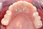 Figure 3 Occlusal view of maxillary transitional hybrid.