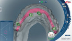 Figure 7 Digital bar design analysis showing occlusal view in relation to tooth arrangement and residual ridge.