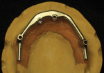 Figure 11 An occlusal view of finished free form milled bar.