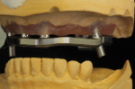 Figure 12 An analysis of restorative space between bar and opposing occlusion.