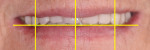 Figure 6 Facial view of maxillary transitional with calibrated lines for esthetic analysis. Note the midline and canine placement that needs to be corrected in definitive.