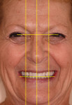 Figure 24 Facial analysis of definitive implant hybrid prosthesis calibrated to interpupillary lines to incisal edge smile line; center of face to midline; ala-to-ala relation to long axis of canines.
