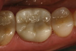 Figure 9 The restoration after placement.