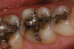 Figure 1 Preoperative photograph shows extreme wear on the patient’s teeth.