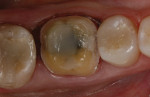Figure 2 Tooth No. 30 after crown preparation.