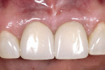 Figure 9  Final restorations exhibit minimal 1 to 1.5 mm of change in papilla height when compared with pre-extraction height.