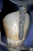 Figure 4 Hand layering with a brush a CL-I feldspathic ceramic.