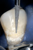 Figure 5 Preoperative view of patient requiring esthetic changes at least up to the bicuspids.