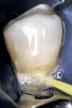 Figure 6 Postoperative view with CL-1 feldspathic porcelain veneers up to the first bicuspid.