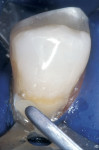 Figure 8  A second opaceous increment was placed in the gingival one half of the preparation, smoothed with a sable brush, and light-cured.