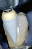 Figure 17 Image of two-molar full-crown porcelain-fused-to-metal restoration made with a CL-IV (CAPTEK) substrate.