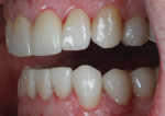 Figure 19 The definitive crowns were tried in, cleaned with Ivoclean, and cemented with Variolink luting composite according to the manufacturer's instructions.