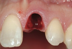Figure 2  Atraumatic tooth removal.