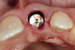 Figure 3  Peri-implant defect after flapless implant placement.