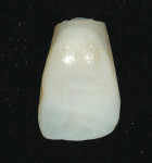 Figure 7  Retrofitted natural tooth shell.